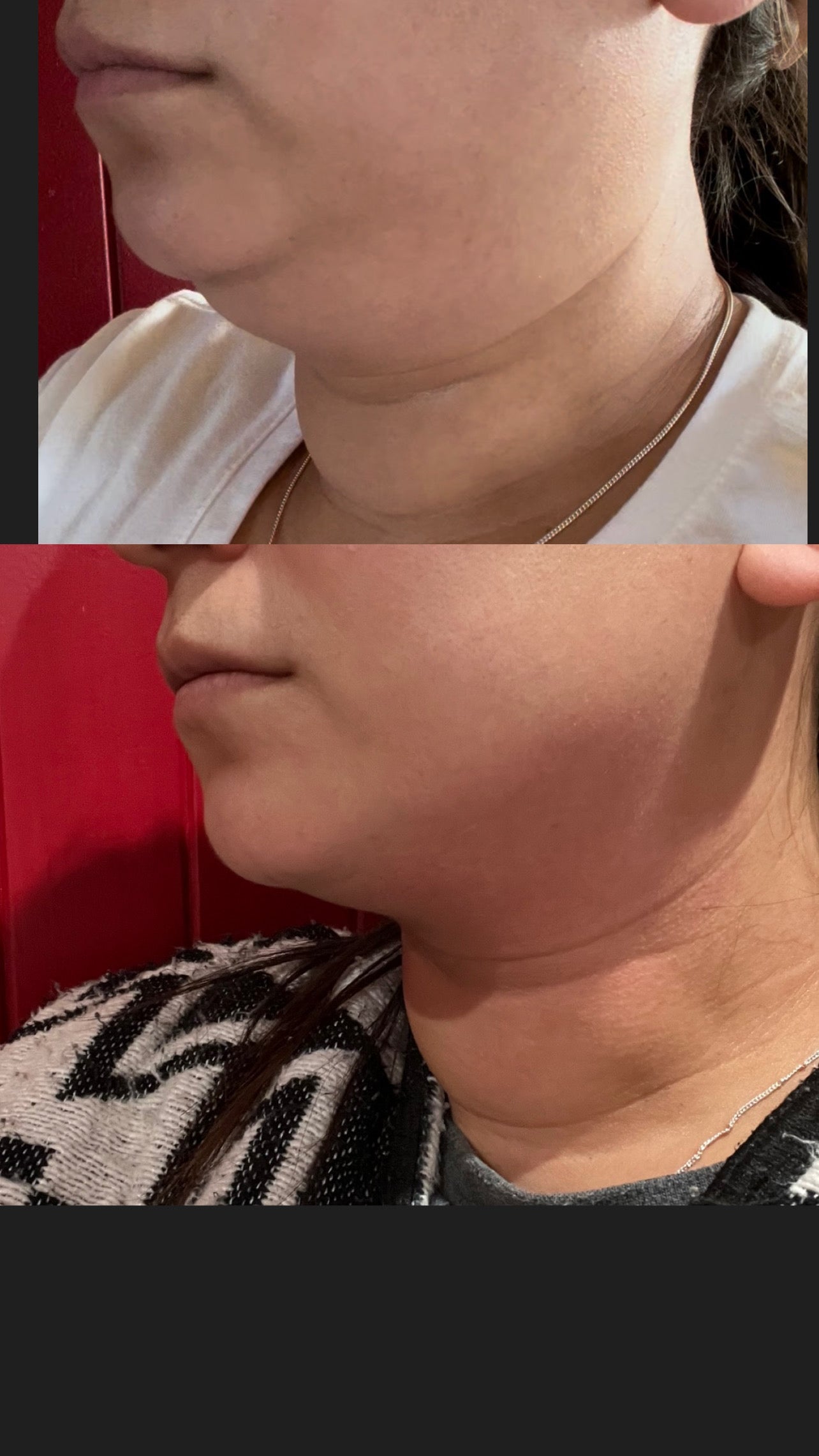 Chin Definition Bundle of 3