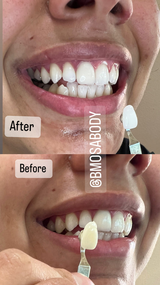 60 Minute REGULAR Cosmetic Teeth Whitening Session