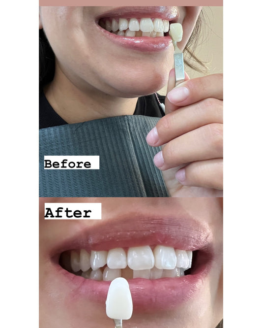 30 Minute (Touch-Up) Cosmetic Teeth Whitening Session